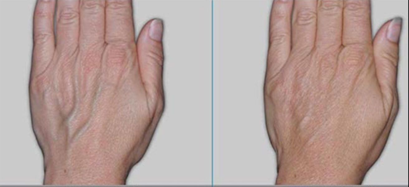 Before and after comparison of a human hand, showing reduced skin texture and vein prominence after a dermatological treatment.
