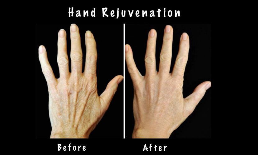 Before and after photos comparing a hand with visible wrinkles and veins to the same hand after skin rejuvenation.