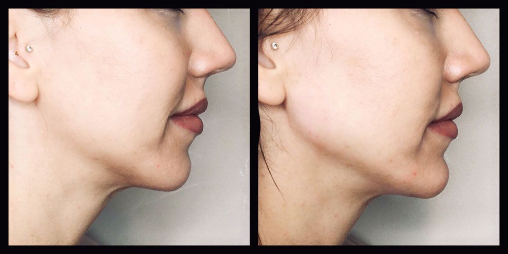 Side-by-side profile view of a jawline before and after a cosmetic procedure, showing reduced submental fullness.