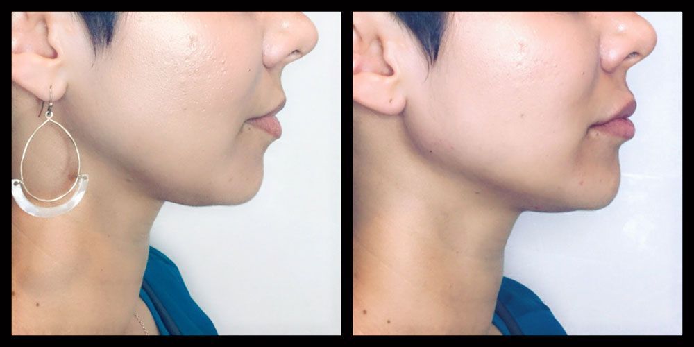 A side-by-side comparison of a jawline before and after a cosmetic procedure, showing a more defined profile.