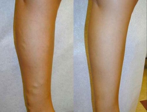 Side-by-side view of two lower legs, one with visible swelling or asymmetry near the calf.