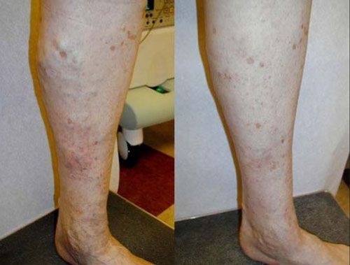 Close-up of lower legs with scattered skin spots and discoloration, shown from two angles.