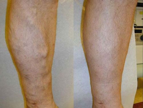 Side-by-side close-up of lower legs, one with visible swelling and discoloration, the other normal