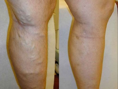 Side-by-side close-up of two lower legs, showing visible varicose veins on one leg.