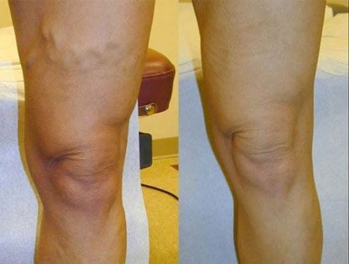 Side-by-side close-up of a leg with a bent knee, showing skin and knee contour differences before and after.