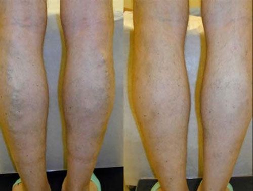 Back view of lower legs, showing calf swelling comparison on a neutral background.