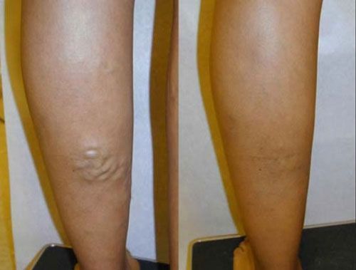 Side-by-side legs showing a varicose vein on the left leg and a smoother right leg