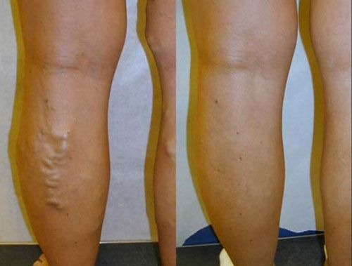 Close-up of two lower legs, one with prominent varicose veins, shown side by side.