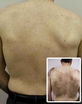 Bare upper back with sparse body hair; inset shows a much hairier upper back for comparison.
