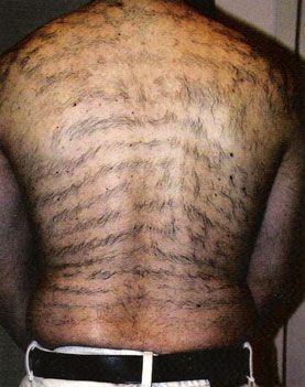 Close-up of a shaved scalp with numerous dark horizontal skin folds or scars, viewed from behind.