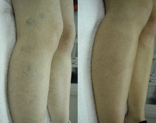 Side-by-side rear view of legs showing before-and-after skin tone differences.