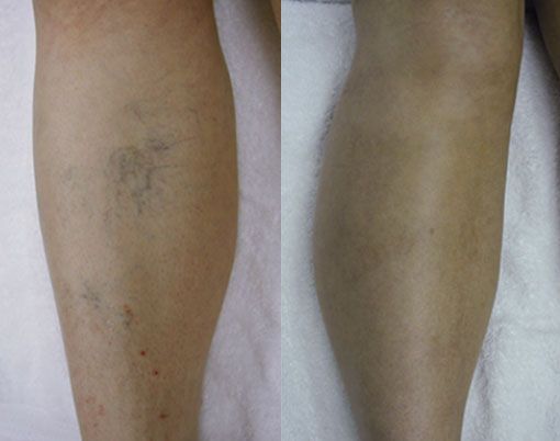 Two lower legs side by side, one with a bruised calf and the other showing normal skin tone.