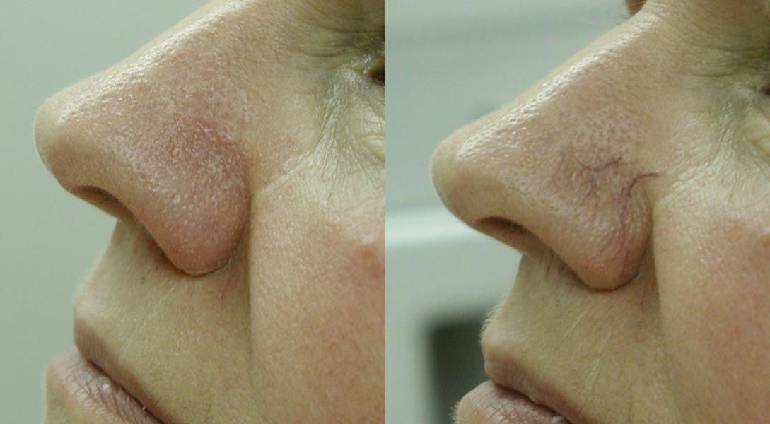 Side-by-side close-ups of a person’s nose profile, showing a subtle before-and-after difference