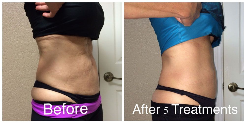 Side-by-side comparison of a torso before and after five skin-tightening or body-contouring treatments.