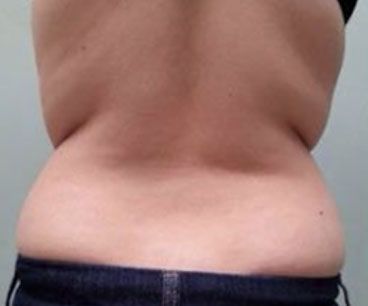 Close-up of a bare lower back and waist above dark jeans, showing a side view of body folds - before