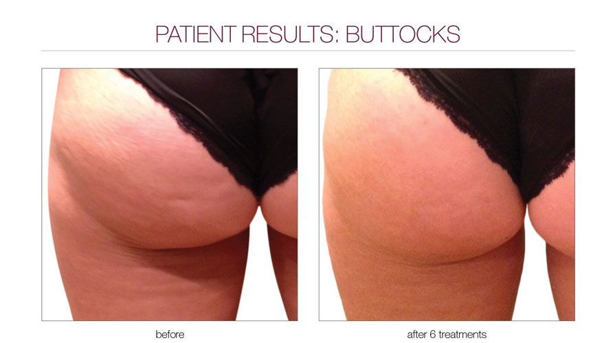 Before and after comparison of cellulite treatment on the buttocks, showing smoother skin texture after treatment.