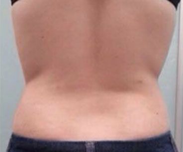 Close-up of a bare lower back with visible skin folds and a waistband at the bottom - after