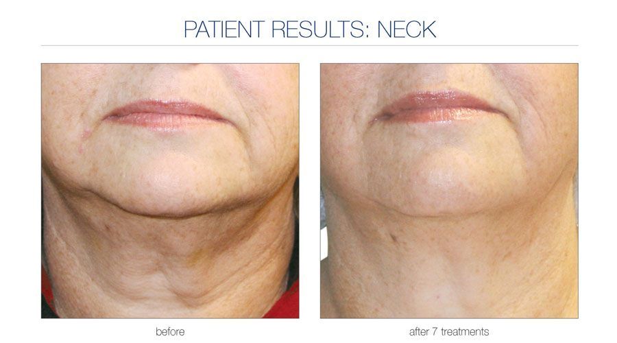 Before and after comparison of a person's neck area, showing reduced skin laxity and wrinkles after 7 treatments.