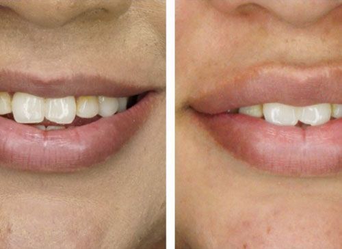 Close-up comparison of two smiling mouths, one with crowded teeth and one with straighter teeth