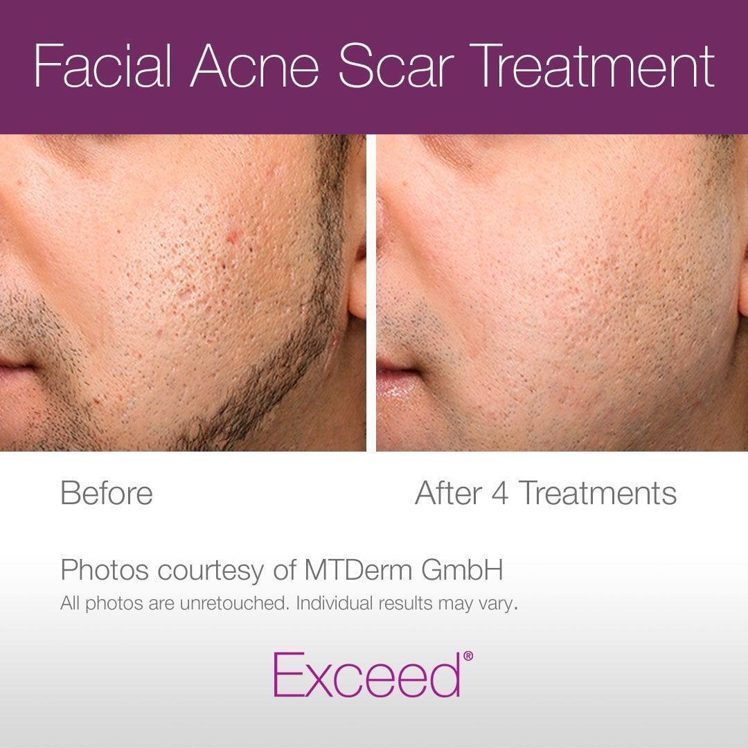 Before and after photos of facial acne scar treatment after four sessions, showing skin texture improvement.