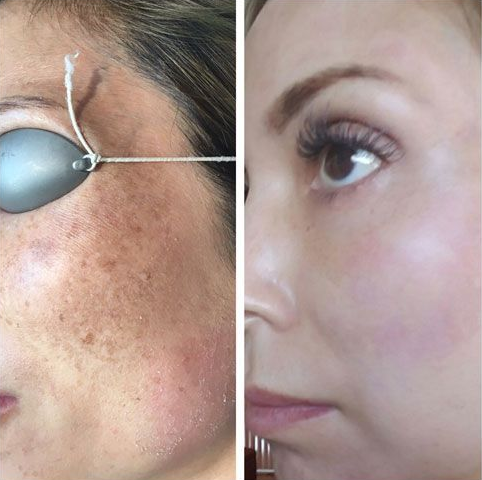 Before-and-after close-up of a face showing a cable-supported under-eye patch on the left and a clearer under-eye area on the right
