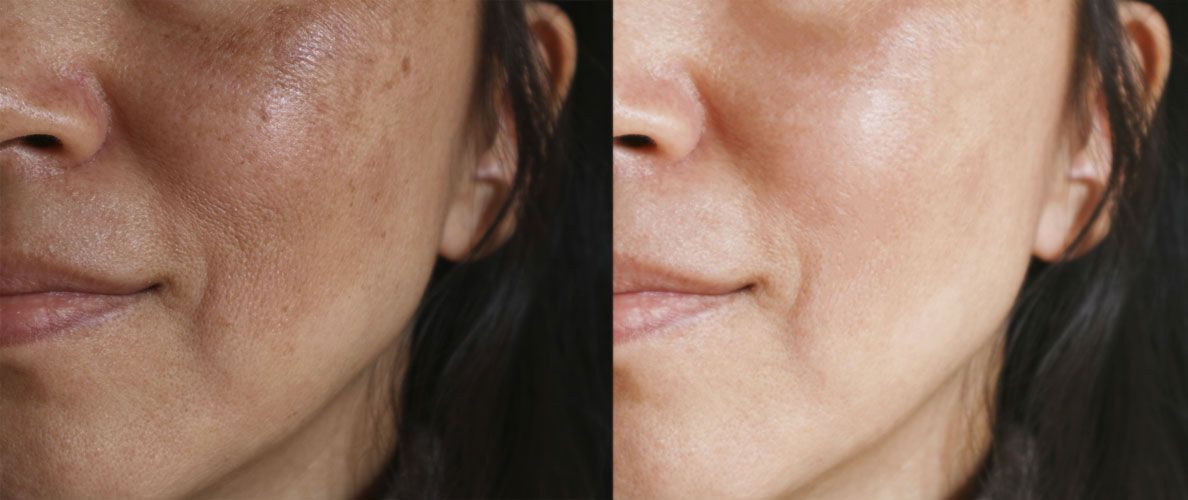 Side-by-side close-up of a face showing darker skin on the left and smoother lighter skin on the right