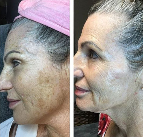 Side-by-side profile photos of a woman’s face, showing skin before and after treatment.