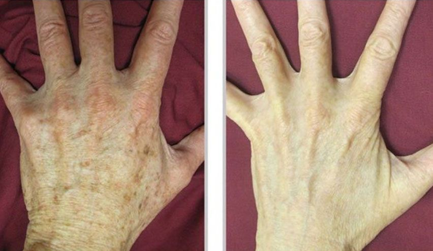 Side-by-side close-up of a hand before and after, showing the skin becoming clearer and less red.