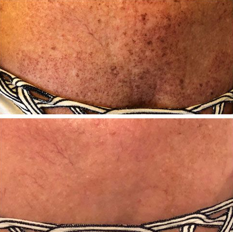Close-up comparison of skin before and after, showing fewer dark spots on the lower image