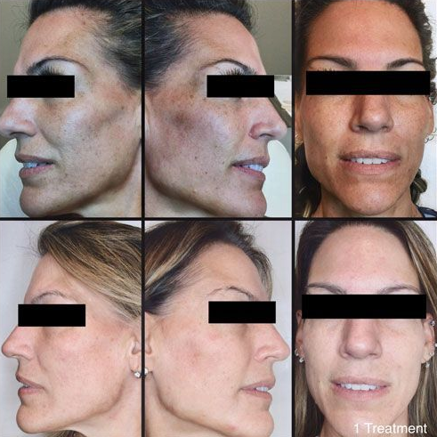Six-panel before-and-after facial profile photos showing treatment changes and improved facial contour