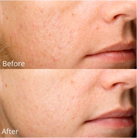 Before and after comparison of a person's cheek showing a reduction in skin texture and acne-related scarring.