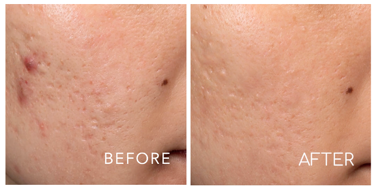 Before and after comparison of a cheek showing reduced acne, scarring, and redness after skin treatment.