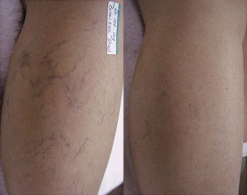 Close-up of two legs, one with visible blue-purple spider veins and a small label tag.