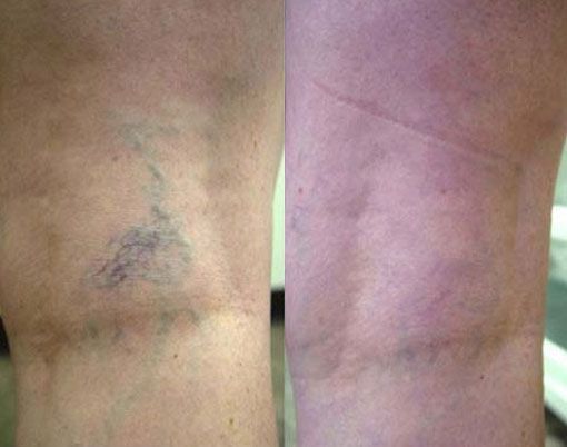 Two forearms shown side by side: one with a dark bluish bruise, the other with pink irritated skin.