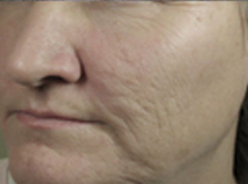 Close-up of a face with visible cheek skin texture and a neutral expression