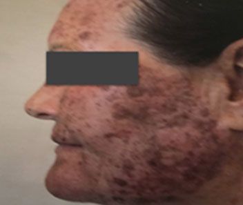 Profile view of a face with widespread dark red and brown skin discoloration