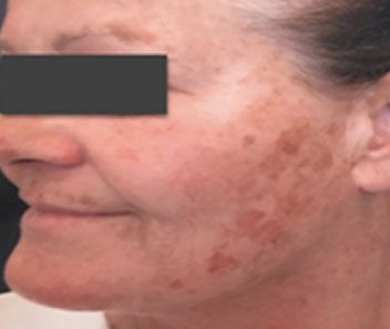 Close-up side profile of a face with dark patches on the cheek and jawline