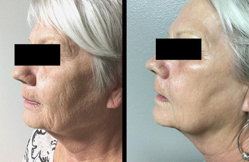 Side-by-side profile photos of the same woman, showing chin and neck before and after treatment.