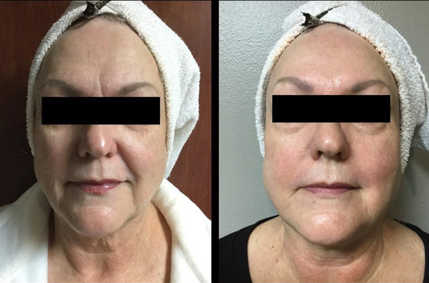 Side-by-side facial photos of a person in a white towel, showing a before-and-after comparison.