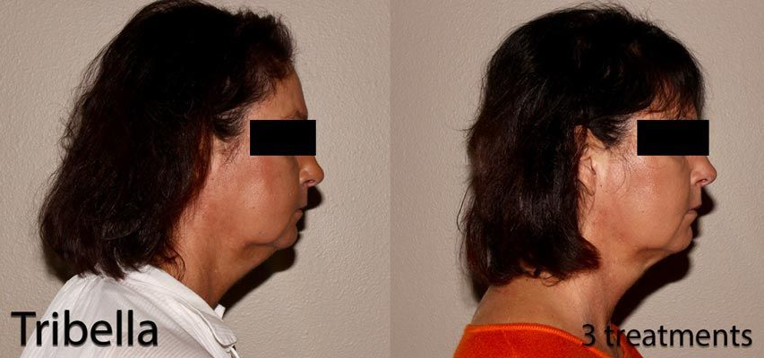 Side-by-side profile photos showing a woman before and after three treatments, with reduced under-chin fullness.