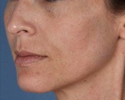 Close-up profile of a woman’s face with visible skin blemishes against a blue background