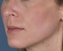Close-up of a woman’s lower face and neck, showing a small red rash on the cheek and jawline.