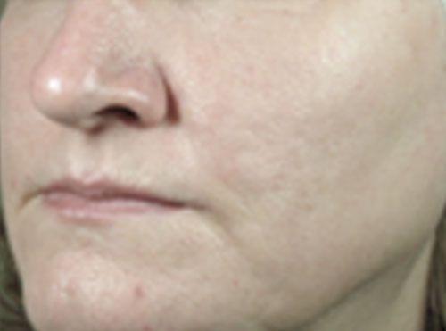 Close-up of a person’s face with a neutral expression, showing the nose, lips, and cheek.