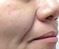 Close-up of a face with visible cheek texture and a slight smile, showing the nose and lips.