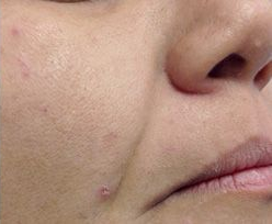 Close-up of a person's cheek and mouth with a small raised blemish near the jawline.