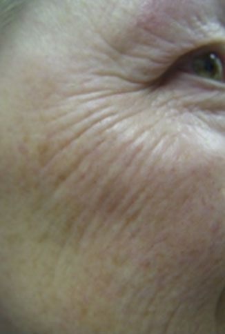 Close-up of a person’s eye and cheek with visible wrinkles and fine lines