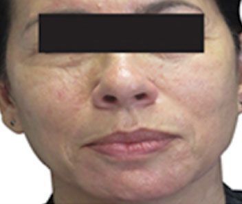 Close-up of a person's face with a black bar obscuring the eyes and visible facial blemishes