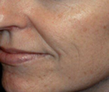 Close-up of a person's lower face with lips, cheek, and nose visible on a neutral background