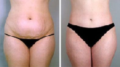 Side-by-side torso comparison showing a before-and-after view of abdominal weight loss in black underwear.