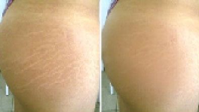 Close-up before-and-after of a heel, showing dry, cracked skin on the left and smoother skin on the right.